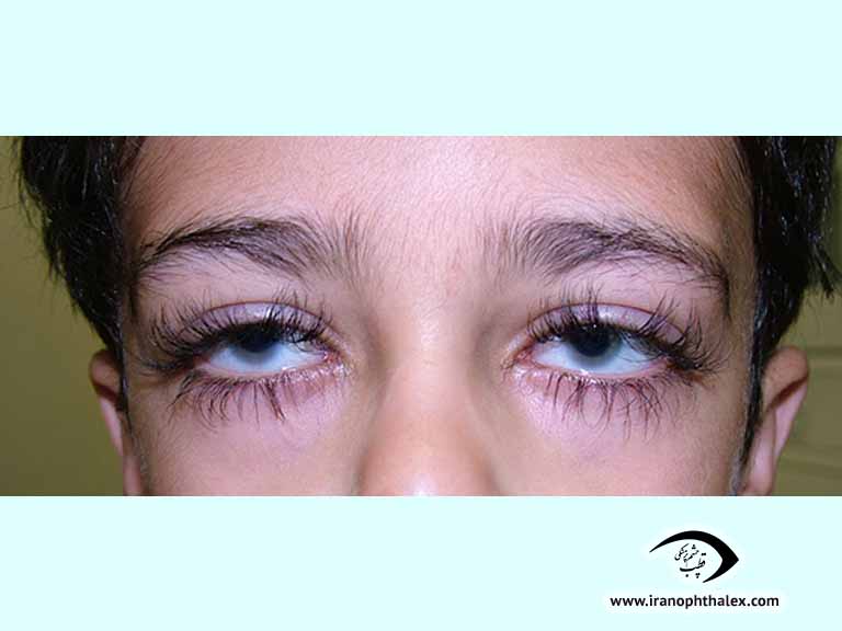 Latanoprost eyelash elangation.jpg